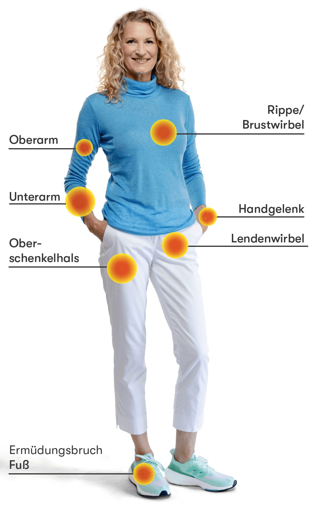 Typische Frakturen bei Osteoporose